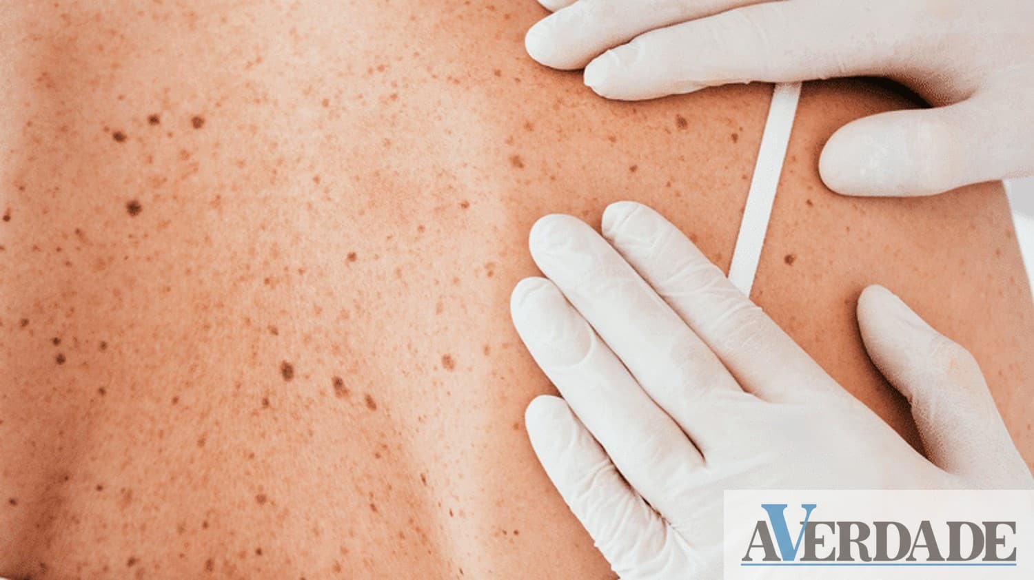 DECO PROTESTE: Cancro da pele, a prevenção pode salvar-lhe a vida